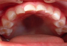 健康な乳歯1