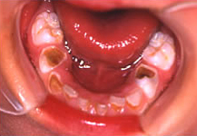 スポーツドリンクによる乳歯のむし歯2